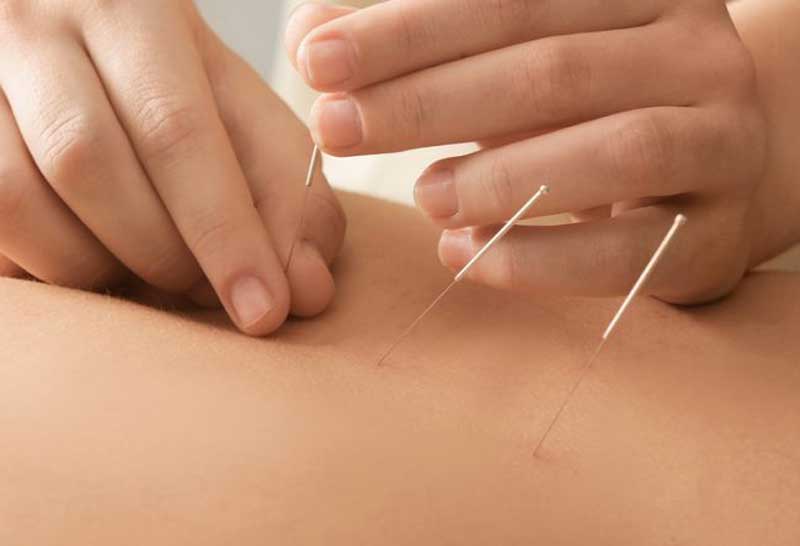 Read more about the article Terapi akupuntur dengan sedikit jarum dapat menghilangkan nyeri seketika