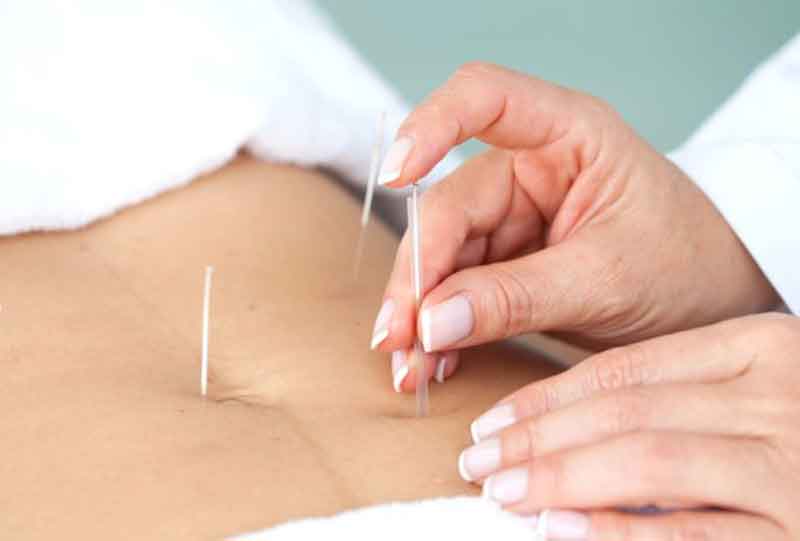 Read more about the article Terapi akupunktur dapat meningkatkan kesuburan wanita
